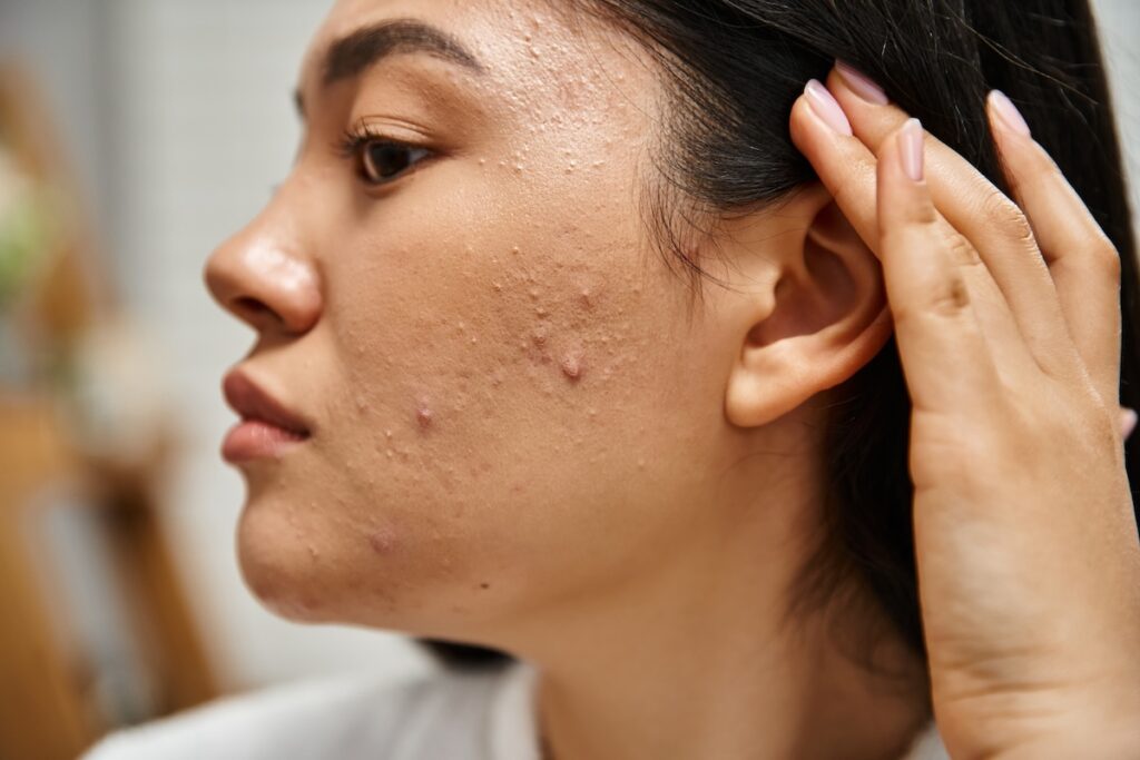 A woman examines her face after an acne scar treatment near Barrington Hills