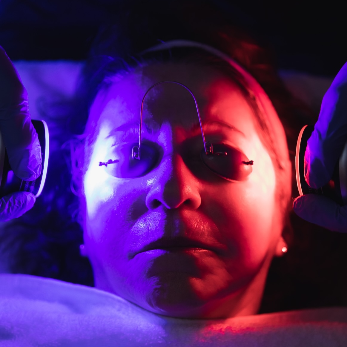 A close-up on a woman's face as she receives an acne scar treatment near Barrington Hills.
